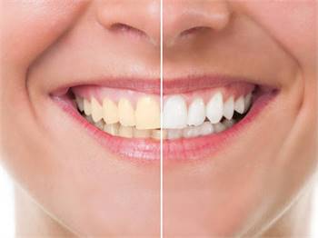 Get A Perfect Shiny White Smile With Teeth Whitening Treatment